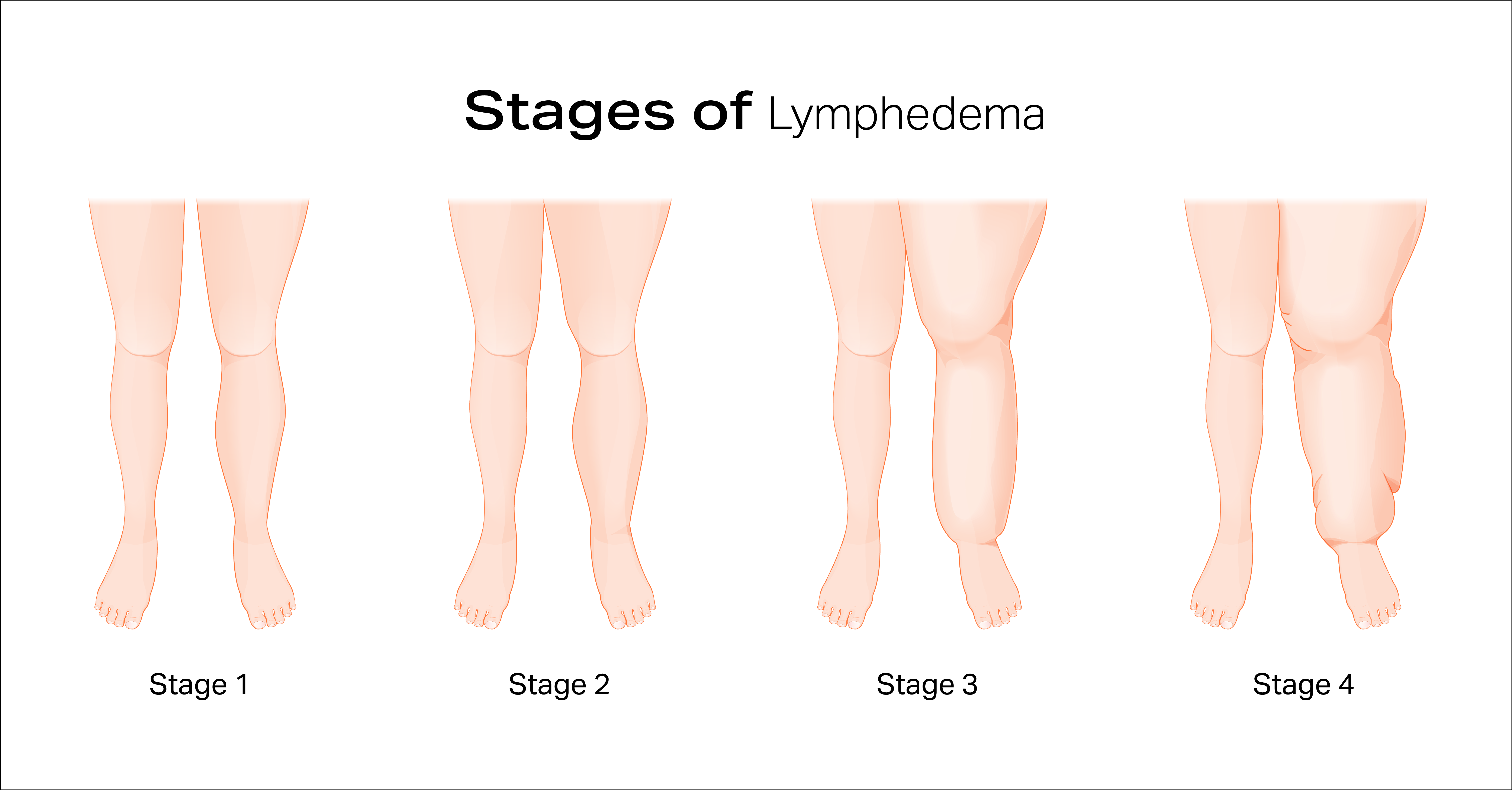 Illustration of different stages of Lymphedema 