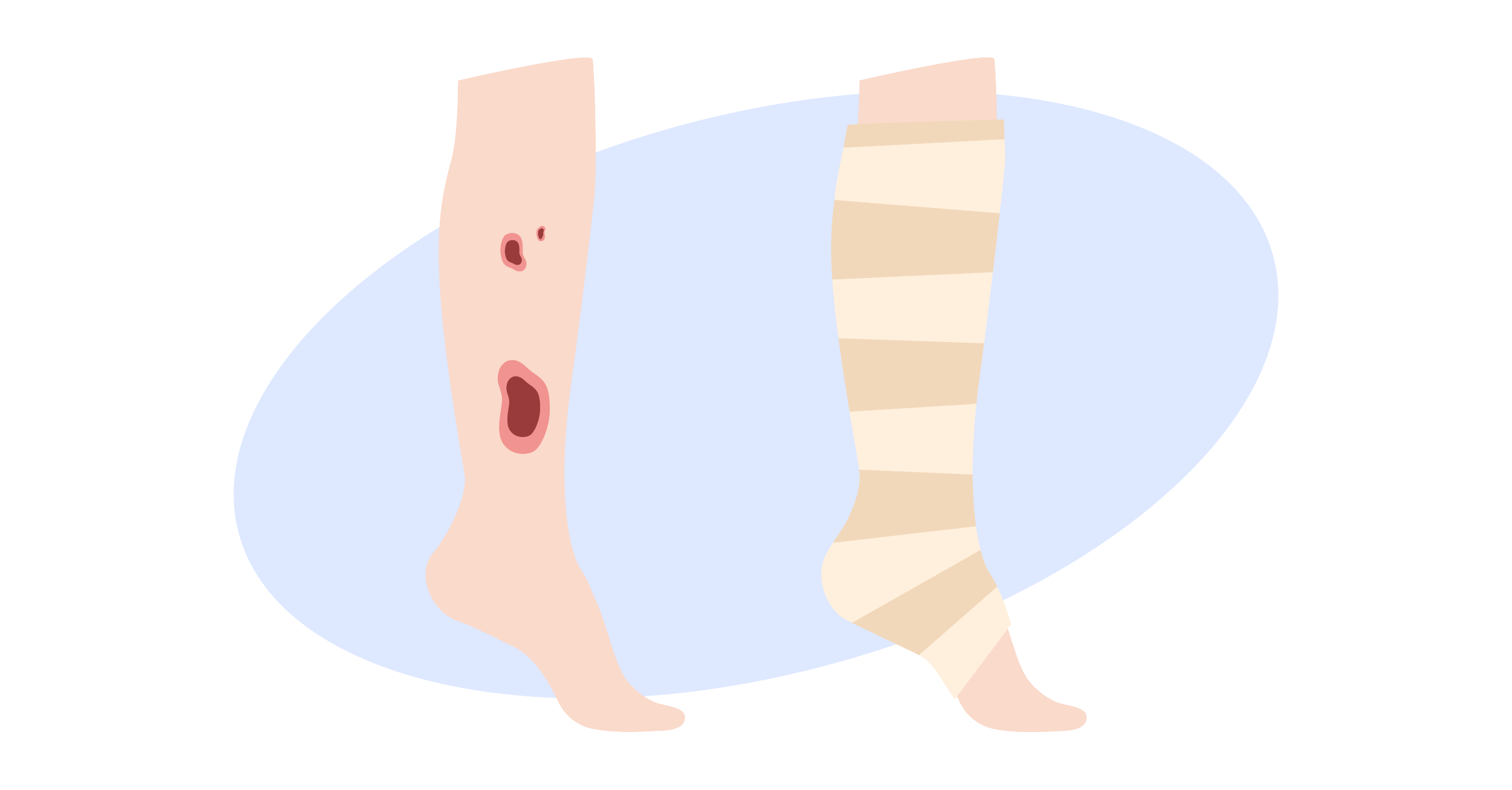 Illustration of Venous Ulcers